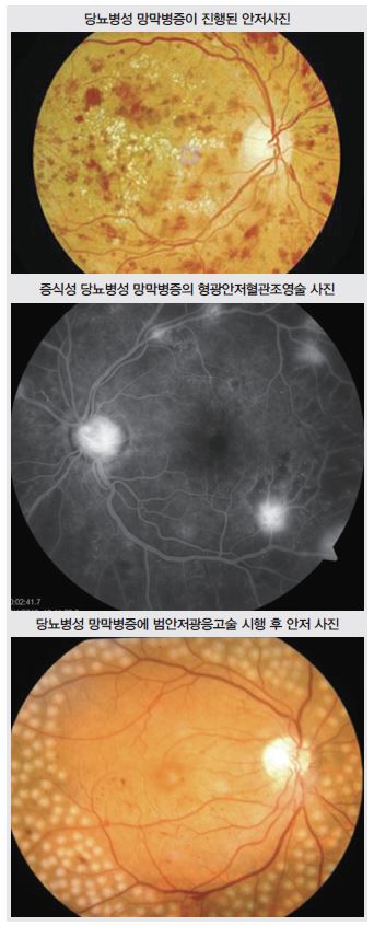 당뇨병성 망막병증 관리