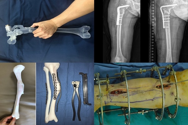 3D프린팅 기술을 활용한 골절 수술 모습. 사진제공=고대 구로병원.