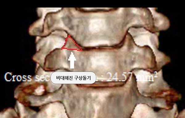 경추협착증 환자의 3차원 CT 사진. 빨간 부분이 경추협착증 환자의 비대해진 '구상돌기'다.