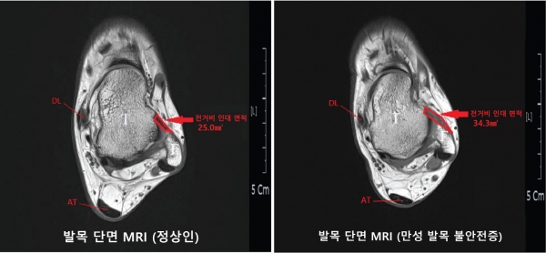 발목 단면 MRI 비교.