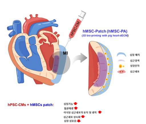 심장패치(중간엽줄기세포)와 심근세포(유도만능줄기세포) 이식을 이용한 심근경색 치료.