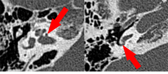 그림1. 좌측은 공동성 이경화증, 우측은 정원공의 침범이 있는 진행성 이경화증의 술전 CT 검사 소견으로, 비교적 간단한 CT 검사를 통해, 공동성 이경화증 및 정원공 침범 여부를 진단할 수 있다. 