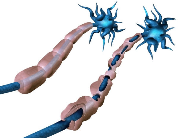 다발성경화증은 신경을 둘러싸고 있는 수초가 면역질환 이상으로 손상되어(오른쪽) 뇌에서 나오는 신경자극 전달이 방해될 때 나타난다.