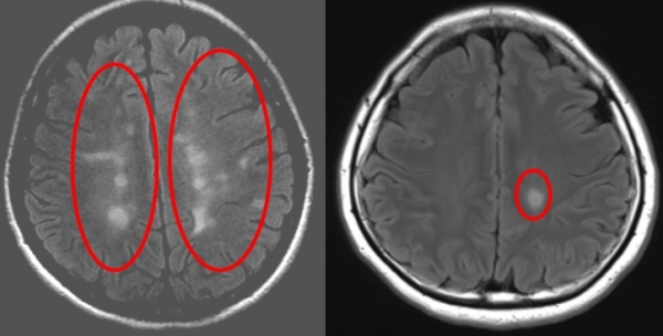 90년대에 출생한 다발성경화증 환자의 뇌 MRI 사진(왼쪽)은 (오른쪽)70년대 출생환자 보다 하얗게 변화된 뇌염증이 초기부터 전체에 퍼져 있다.