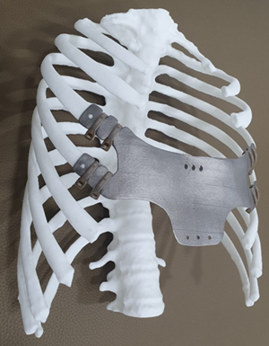 3D프린팅 순수 티타늄 인공흉골 이미지 사진(제공: 벤타쓰리디)