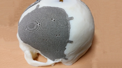 환자용 두개골에 맞춘 의료용 3D 프린팅 모델