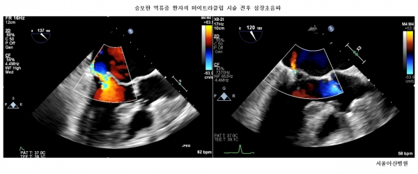 Ultrasonography of patient before MitraClip procedure (left) and after procedure (right).