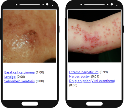 사진1. 좌측 사진은 검버섯으로 오인하기 쉬운 기저세포암(Basal cell carcinoma)을 AI가 정확히 진단한 결과이며, 우측 사진은 아토피피부염으로 오진하기 쉬운 단순포진 바이러스에 의한 포진상 습진(Eczema herpeticum)을 AI가 정확히 진단한 모습이다. (출처: http://modelderm.com)