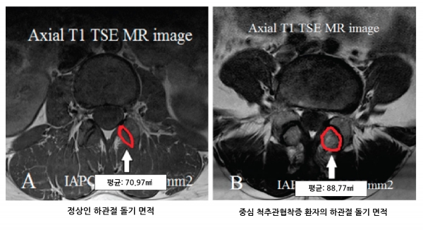 정상인과 중심척추관협착증 환자 하관절 돌기 면적을 비교한 MRI 영상