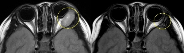 수술 전 MRI 검사에서 왼쪽 안와의 외직근에 발생한 안와육종의 모습(왼쪽)과 수술 후 안와육종이 제거된 모습