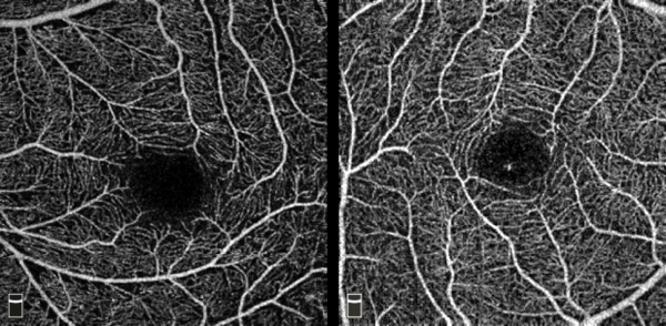 빛간섭단층촬영 혈관조영술(OCTA)을 이용한 근시안(좌)과 정상안(우)의 황반부 망막혈관 비교 사진. 사진 출처: 서울아산병원
