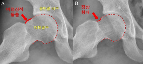 고관절 충돌증후군 환자의 관절경수술 전후 엑스선 영상. 고관절경술 전(A)에는 대퇴골두가 볼록하게 돌출돼 있던 반면, 수술 후(B)에는 돌출된 부위가 제거돼 정상적인 대퇴골 모양을 회복했다.