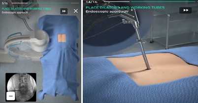 ▲Touch Surgery 척추내시경수술 교육 프로그램 중 단계별 영상 샘플.