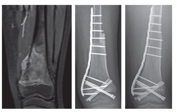 수술 이전 환자의 MRI 사진(왼쪽) 종양이 발생했음을 확인할 수 있다.수술 직후(가운데)와 수술 후 4년 이후(오른쪽) 환자의 단순방사선사진. 종양을 제거한 부위는  골이식을 통해 개건했다. 해당 환자의 무릎관절운동은 완벽하게 정상수준까지 회복됐다.