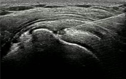 그림1. 회전근개 부분 파열 부위에 초음파 유도하 아텔로콜라겐 주입 사진.