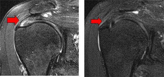 그림2. 왼쪽: 회전근개 부분 파열(화살표 부위) MRI 검사 장면. 회전근 개 부분 파열 부위에 아텔로콜라겐 주사 6개월 후 시행한 MRI 검사 결과(오른쪽)에서 회전근 개 파열 부위가 회복된 것으로 나타났다.