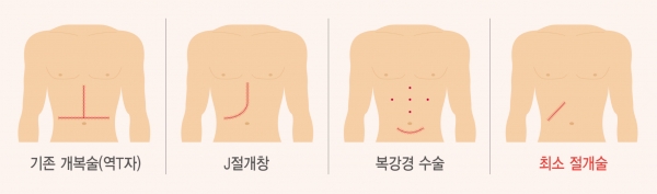 간 기증자 수술별 흉터 그림. 사진 제공: 서울아산병원.