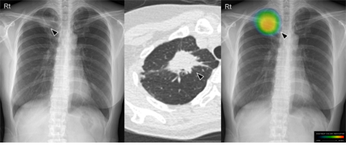 그림 1. 건강검진으로 촬영 한 흉부X선 사진. 우측 폐 상부에 폐암이 의심 되는 음영이 있고 (좌), 이는 흉부 전산화 단층촬영상에서도 폐암이 의심됨 (가운데). 인공지능 시스템은 이 병변의 존재와 위치를 식별하여 폐암으로 판정함 (우).