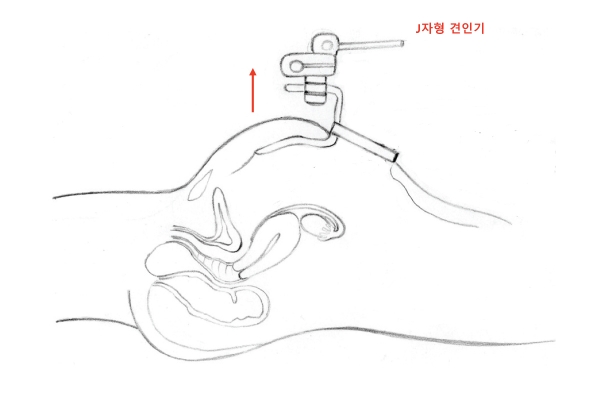 사진1. 가톨릭관동대 국제성모병원 산부인과 김보욱, 황종하 교수팀이 개발한 새로운 복강경 수술법(J자형 견인기).