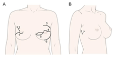 일반적인 유두 보존 유방 절제술(A)과 로봇 유방 절제술(B)에서의 절개흔