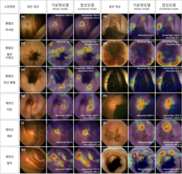 ▲​딥러닝 알고리즘이 소장 병변을 탐지해 시각화한 영상. 인공지능이 병변으로 판단한 부분이 Grad-CAM에 의해 붉은색으로 표시됨.