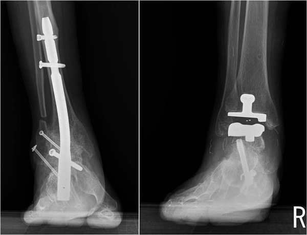 (왼쪽부터) 발목 유합술 수술과 발목 인공관절치환술(한림대동탄성심병원 제공)