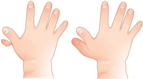 저형성증에 해당하는 엄지손가락 다지증(좌)과 저형성증이 아닌 엄지손가락 다지증(우). 사진 제공: 서울아산병원.