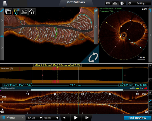 OCT를 이용한 심장혈관 스텐트 삽입술 영상 이미지