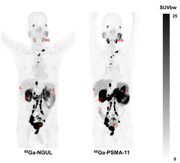그림 1. 전이 전립선암 환자에게 PSMA-NGUL을 주입한 경우(좌)와 PSMA-11을 주입한 (우) 경우의 PET/CT 영상.   좌측 PSMA-NGUL의 경우 전립선암의 원발병소 (전립선), 임파절 전이병소, 뼈전이 병소가 뚜렷하고, 다른 장기들이 훨씬 흐리게 보여 보다 명확하게 진단할 수 있다.