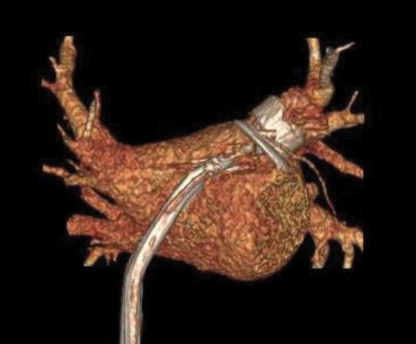혈전이 생기는 좌심방이를 메워 혈액이 흘러 들어가지 않도록 하는 좌심방이 폐색술(LAAO), 심방세동 환자의 뇌졸중 발생을 예방하기 위해 시행된다. 사진 출처: 세브란스병원.