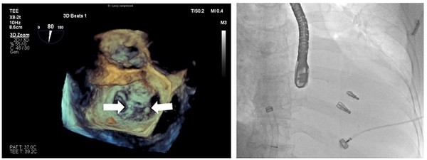(좌) 3D 심장초음파에서 보이는 마이트라클립 장착된 모습. (우) 승모판막에 고정된 마이트라 클립 2개