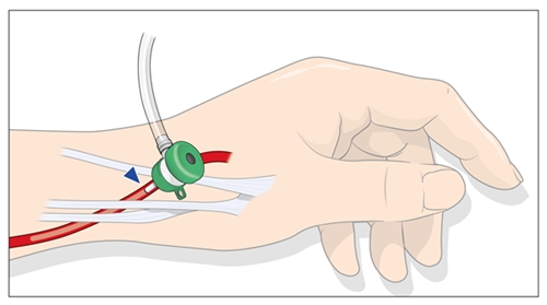 스너프박스 접근법(최소절개 접근법) 모식도. 손등 부위 동맥을 통해 심장으로 접근하는 시술법이다