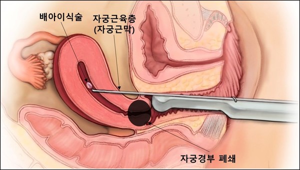 [그림. 자궁경부가 폐쇄된 경우 시행할 수 있는 '자궁근막 통과 배아이식술']