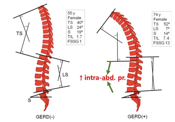 그림 2. 반듯이 서 있는 자세에서 척추의 형태와 GERD 유무와의 관계​​​​​​​​​​​​​​Ref. Imagama S, et al. Eur Spine J. 2012;21:2149-2157.