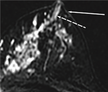 비종괴성 조영증강