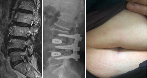 3년 동안 허리 통증 및 다리 방사통을 겪은 환자(72세, 여성) ‘배꼽경유 척추유합술’ 사례