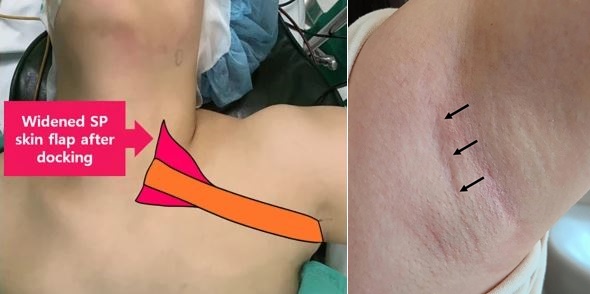 [왼쪽] 겨드랑이를 절개해 갑상선암 수술을 진행하는 2단계 견인법 모습 [오른쪽] 2단계 견인법을 통해 자연 주름에 절개 수술 후 6개월 경과한 갑상선암 환자 사례  