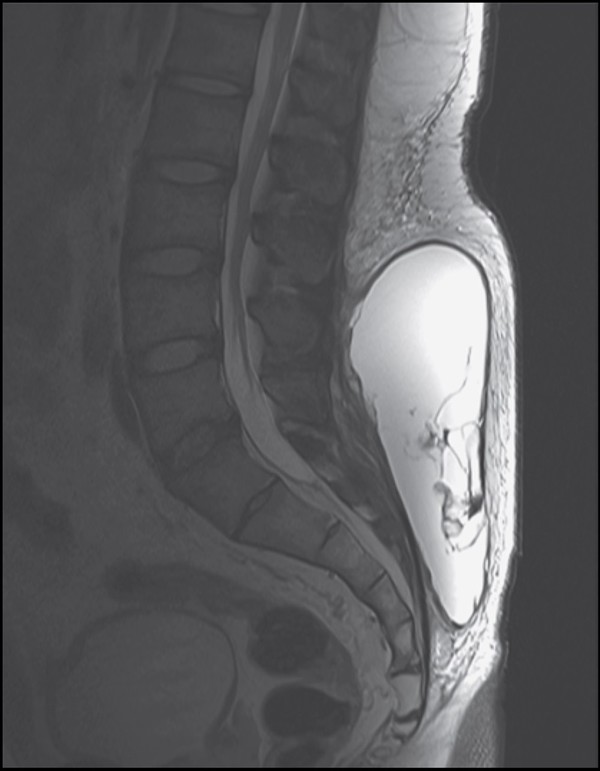 ▲박형열, 김영훈 교수가 NEJM에 보고한 Morel–Lavallée 병변 MRI 소견 사진.