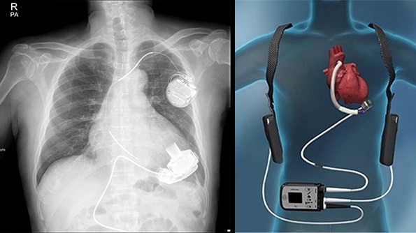 HeartMate3 삽입 흉부방사선촬영 및 모식도 