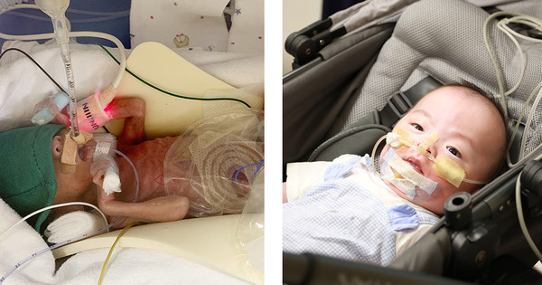 ▲(좌부터)초극소 미숙아로 태어난 하진이의 생후 2주차 모습, 6Kg으로 건강하게 성장한 하진이의 첫 번째 외래 진료 모습.