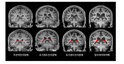 뇌 영상에서 맥락얼기의 부피(빨간색)가 치매가 진행함에 따라 더 증가한 것을 확인할 수 있다.