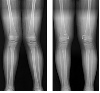 그림. 외반슬(엑스자 다리)에 대해 8자 금속판 이용한 대퇴골 내측 반성장판 유합술 후 교정된 환자(좌- 교정 전, 우-교정 후)