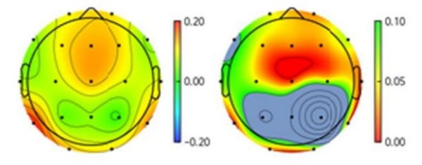 알코올 금단성 경련 환자(우)와 대조군(좌)의 뇌파 파형 비교. 알코올 금단성 경련 환자의 뇌파에서 대조군에 비해 인지 및 기억 기능과 관련된 알파파형이 유의하게 감소했다.
