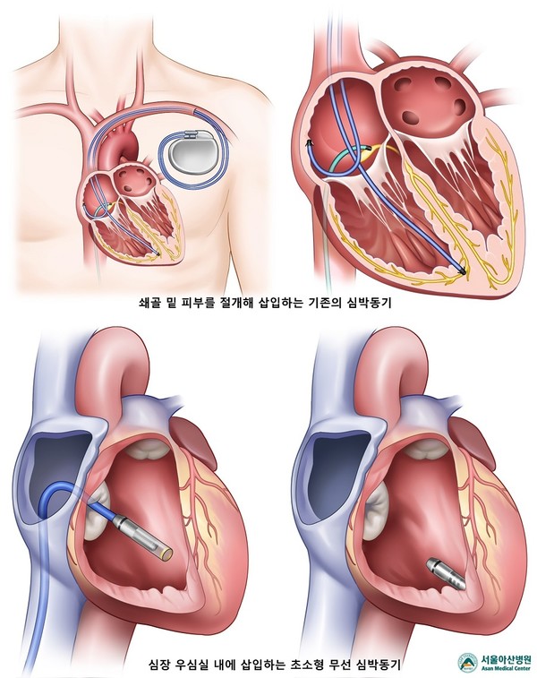 기존의 심박동기(사진 위)와 무선 심박동기 시술 과정