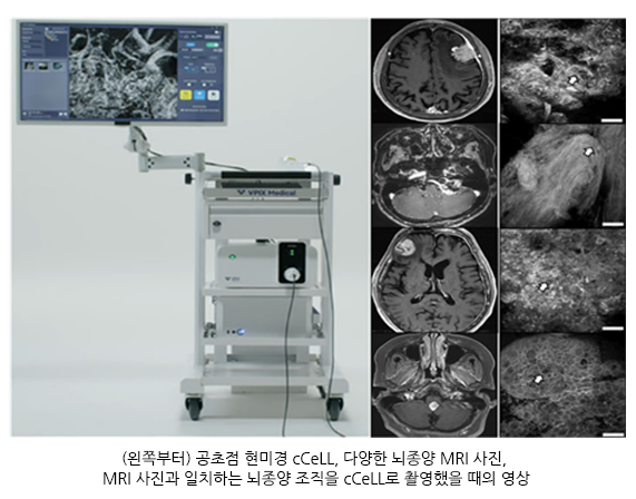 공초첨 현미경 cCeLL, 수술 중 실시간 뇌종양 진단 가능성 입증
