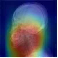 두경부 X-ray 영상을 활용한 수면무호흡증 진단 예시.딥러닝 알고리즘이 수면무호흡증 여부를 분류하는 이미지 상 특이점의 위치(붉은색)를 확인할 수 있다.