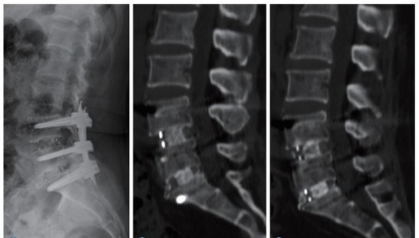 ABM/P-15 골이식재를 사용한 척추 유합술 후 모습