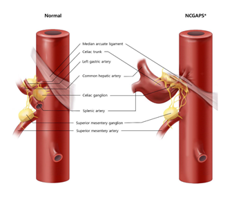 호두까기복통이 있는 경우(오른쪽) 정상인 왼쪽과 달리 정중궁인대가 복강동맥(Celiac Trunk)을 가로지르며 복강신경절을 눌러 통증을 유발한다.