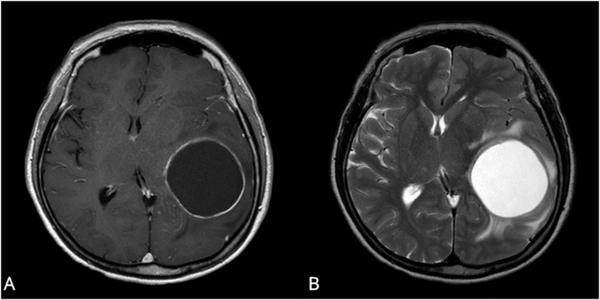 ▲교모세포종 환자 MRI 사진. 체액(fluid) 성분이 대부분인 낭종(cyst)이 있는 낭성군(A)이 비낭성군(B)에 비해 유의하게 생존기간이 길었다.