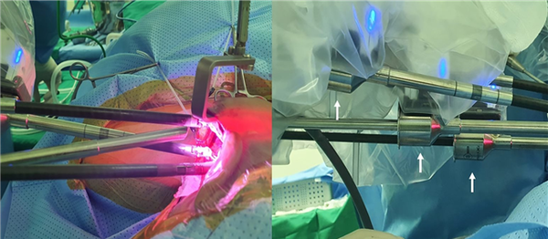 4개의 로봇팔을 서로 충돌시키지 않는 방법으로 수술을 진행하는 모습
